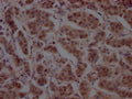 IHC image of CSB-RA898115A0HU diluted at 1:100 and staining in paraffin-embedded human breast cancer performed on a Leica BondTM system. After dewaxing and hydration, antigen retrieval was mediated by high pressure in a citrate buffer (pH 6.0) . Section was blocked with 10% normal goat serum 30min at RT. Then primary antibody (1% BSA) was incubated at 4℃ overnight. The primary is detected by a Goat anti-rabbit IgG polymer labeled by HRP and visualized using 0.05% DAB.