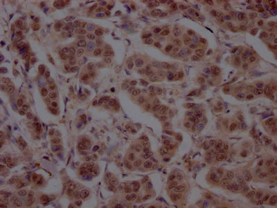 IHC image of CSB-RA898115A0HU diluted at 1:100 and staining in paraffin-embedded human breast cancer performed on a Leica BondTM system. After dewaxing and hydration, antigen retrieval was mediated by high pressure in a citrate buffer (pH 6.0) . Section was blocked with 10% normal goat serum 30min at RT. Then primary antibody (1% BSA) was incubated at 4℃ overnight. The primary is detected by a Goat anti-rabbit IgG polymer labeled by HRP and visualized using 0.05% DAB.