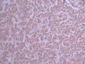 IHC image of CSB-RA901944A0HU diluted at 1:100 and staining in paraffin-embedded human breast cancer performed on a Leica BondTM system. After dewaxing and hydration, antigen retrieval was mediated by high pressure in a citrate buffer (pH 6.0) . Section was blocked with 10% normal goat serum 30min at RT. Then primary antibody (1% BSA) was incubated at 4°C overnight. The primary is detected by a Goat anti-rabbit polymer IgG labeled by HRP and visualized using 0.05% DAB.