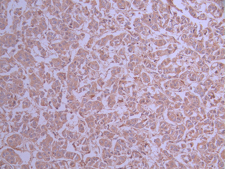 IHC image of CSB-RA901944A0HU diluted at 1:100 and staining in paraffin-embedded human breast cancer performed on a Leica BondTM system. After dewaxing and hydration, antigen retrieval was mediated by high pressure in a citrate buffer (pH 6.0) . Section was blocked with 10% normal goat serum 30min at RT. Then primary antibody (1% BSA) was incubated at 4°C overnight. The primary is detected by a Goat anti-rabbit polymer IgG labeled by HRP and visualized using 0.05% DAB.