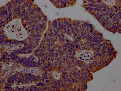 IHC image of CSB-RA903061A0HU diluted at 1:100 and staining in paraffin-embedded human ovarian cancer performed on a Leica BondTM system. After dewaxing and hydration, antigen retrieval was mediated by high pressure in a citrate buffer (pH 6.0) . Section was blocked with 10% normal goat serum 30min at RT. Then primary antibody (1% BSA) was incubated at 4℃ overnight. The primary is detected by a Goat anti-rabbit IgG polymer labeled by HRP and visualized using 0.05% DAB.