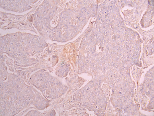 IHC image of CSB-RA903925A0HU diluted at 1:100 and staining in paraffin-embedded human melanoma cancer performed on a Leica BondTM system. After dewaxing and hydration, antigen retrieval was mediated by high pressure in a citrate buffer (pH 6.0) . Section was blocked with 10% normal goat serum 30min at RT. Then primary antibody (1% BSA) was incubated at 4°C overnight. The primary is detected by a Goat anti-rabbit polymer IgG labeled by HRP and visualized using 0.05% DAB.