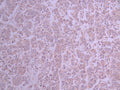 IHC image of CSB-RA909458A0HU diluted at 1:100 and staining in paraffin-embedded human breast cancer performed on a Leica BondTM system. After dewaxing and hydration, antigen retrieval was mediated by high pressure in a citrate buffer (pH 6.0) . Section was blocked with 10% normal goat serum 30min at RT. Then primary antibody (1% BSA) was incubated at 4°C overnight. The primary is detected by a Goat anti-rabbit polymer IgG labeled by HRP and visualized using 0.05% DAB.