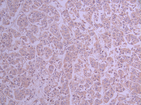 IHC image of CSB-RA909458A0HU diluted at 1:100 and staining in paraffin-embedded human breast cancer performed on a Leica BondTM system. After dewaxing and hydration, antigen retrieval was mediated by high pressure in a citrate buffer (pH 6.0) . Section was blocked with 10% normal goat serum 30min at RT. Then primary antibody (1% BSA) was incubated at 4°C overnight. The primary is detected by a Goat anti-rabbit polymer IgG labeled by HRP and visualized using 0.05% DAB.