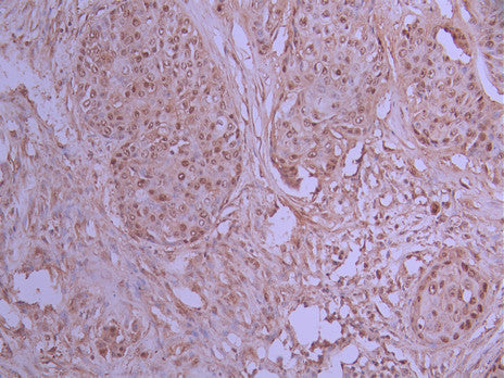 IHC image of CSB-RA912122A0HU diluted at 1:100 and staining in paraffin-embedded human pancreatic cancer performed on a Leica BondTM system. After dewaxing and hydration, antigen retrieval was mediated by high pressure in a citrate buffer (pH 6.0) . Section was blocked with 10% normal goat serum 30min at RT. Then primary antibody (1% BSA) was incubated at 4°C overnight. The primary is detected by a Goat anti-rabbit polymer IgG labeled by HRP and visualized using 0.05% DAB.