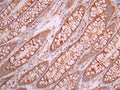 IHC image of CSB-RA912925A0HU diluted at 1:100 and staining in paraffin-embedded human colorectal cancer performed on a Leica BondTM system. After dewaxing and hydration, antigen retrieval was mediated by high pressure in a citrate buffer (pH 6.0). Section was blocked with 10% normal goat serum 30min at RT. Then primary antibody (1% BSA) was incubated at 4°C overnight. The primary is detected by a Goat anti-rabbit polymer IgG labeled by HRP and visualized using 0.05% DAB.