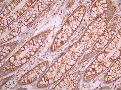 IHC image of CSB-RA912925A0HU diluted at 1:100 and staining in paraffin-embedded human colorectal cancer performed on a Leica BondTM system. After dewaxing and hydration, antigen retrieval was mediated by high pressure in a citrate buffer (pH 6.0). Section was blocked with 10% normal goat serum 30min at RT. Then primary antibody (1% BSA) was incubated at 4°C overnight. The primary is detected by a Goat anti-rabbit polymer IgG labeled by HRP and visualized using 0.05% DAB.
