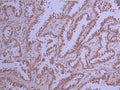 IHC image of CSB-RA914462A0HU diluted at 1:100 and staining in paraffin-embedded human lung cancer performed on a Leica BondTM system. After dewaxing and hydration, antigen retrieval was mediated by high pressure in a citrate buffer (pH 6.0) . Section was blocked with 10% normal goat serum 30min at RT. Then primary antibody (1% BSA) was incubated at 4°C overnight. The primary is detected by a Goat anti-rabbit polymer IgG labeled by HRP and visualized using 0.05% DAB.