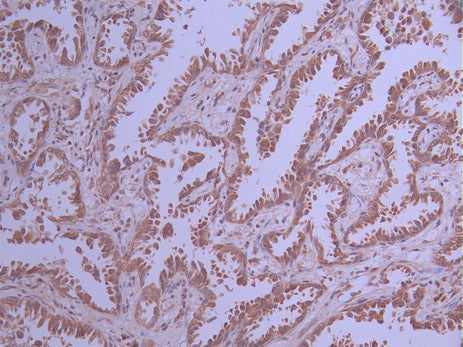 IHC image of CSB-RA914462A0HU diluted at 1:100 and staining in paraffin-embedded human lung cancer performed on a Leica BondTM system. After dewaxing and hydration, antigen retrieval was mediated by high pressure in a citrate buffer (pH 6.0) . Section was blocked with 10% normal goat serum 30min at RT. Then primary antibody (1% BSA) was incubated at 4°C overnight. The primary is detected by a Goat anti-rabbit polymer IgG labeled by HRP and visualized using 0.05% DAB.