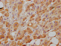 IHC image of CSB-RA921474A0HU diluted at 1:100 and staining in paraffin-embedded human liver tissue performed on a Leica BondTM system. After dewaxing and hydration, antigen retrieval was mediated by high pressure in a citrate buffer (pH 6.0) . Section was blocked with 10% normal goat serum 30min at RT. Then primary antibody (1% BSA) was incubated at 4℃ overnight. The primary is detected by a Goat anti-rabbit IgG polymer labeled by HRP and visualized using 0.05% DAB.