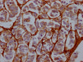 IHC image of CSB-RA921689A0HU diluted at 1:100 and staining in paraffin-embedded human breast cancer performed on a Leica BondTM system. After dewaxing and hydration, antigen retrieval was mediated by high pressure in a citrate buffer (pH 6.0) . Section was blocked with 10% normal goat serum 30min at RT. Then primary antibody (1% BSA) was incubated at 4℃ overnight. The primary is detected by a Goat anti-rabbit IgG polymer labeled by HRP and visualized using 0.05% DAB.