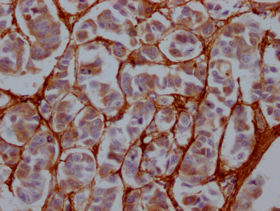 IHC image of CSB-RA921689A0HU diluted at 1:100 and staining in paraffin-embedded human breast cancer performed on a Leica BondTM system. After dewaxing and hydration, antigen retrieval was mediated by high pressure in a citrate buffer (pH 6.0) . Section was blocked with 10% normal goat serum 30min at RT. Then primary antibody (1% BSA) was incubated at 4℃ overnight. The primary is detected by a Goat anti-rabbit IgG polymer labeled by HRP and visualized using 0.05% DAB.