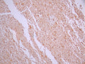 IHC image of CSB-RA922077A0HU diluted at 1:100 and staining in paraffin-embedded human glioma cancer performed on a Leica BondTM system. After dewaxing and hydration, antigen retrieval was mediated by high pressure in a citrate buffer (pH 6.0). Section was blocked with 10% normal goat serum 30min at RT. Then primary antibody (1% BSA) was incubated at 4°C overnight. The primary is detected by a Goat anti-rabbit polymer IgG labeled by HRP and visualized using 0.05% DAB.