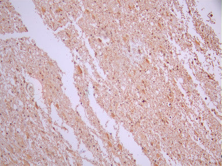 IHC image of CSB-RA922077A0HU diluted at 1:100 and staining in paraffin-embedded human glioma cancer performed on a Leica BondTM system. After dewaxing and hydration, antigen retrieval was mediated by high pressure in a citrate buffer (pH 6.0). Section was blocked with 10% normal goat serum 30min at RT. Then primary antibody (1% BSA) was incubated at 4°C overnight. The primary is detected by a Goat anti-rabbit polymer IgG labeled by HRP and visualized using 0.05% DAB.