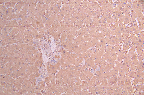 IHC image of CSB-RA926100A0HU diluted at 1:100 and staining in paraffin-embedded human liver cancer performed on a Leica BondTM system. After dewaxing and hydration, antigen retrieval was mediated by high pressure in a citrate buffer (pH 6.0) . Section was blocked with 10% normal goat serum 30min at RT. Then primary antibody (1% BSA) was incubated at 4°C overnight. The primary is detected by a Goat anti-rabbit polymer IgG labeled by HRP and visualized using 0.05% DAB.