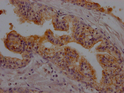 IHC image of CSB-RA927191A0HU diluted at 1:100 and staining in paraffin-embedded human prostate cancer performed on a Leica BondTM system. After dewaxing and hydration, antigen retrieval was mediated by high pressure in a citrate buffer (pH 6.0) . Section was blocked with 10% normal goat serum 30min at RT. Then primary antibody (1% BSA) was incubated at 4℃ overnight. The primary is detected by a Goat anti-rabbit IgG polymer labeled by HRP and visualized using 0.05% DAB.