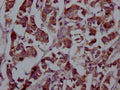 IHC image of CSB-RA927449A0HU diluted at 1:100 and staining in paraffin-embedded human breast cancer performed on a Leica BondTM system. After dewaxing and hydration, antigen retrieval was mediated by high pressure in a citrate buffer (pH 6.0) . Section was blocked with 10% normal goat serum 30min at RT. Then primary antibody (1% BSA) was incubated at 4℃ overnight. The primary is detected by a Goat anti-rabbit IgG polymer labeled by HRP and visualized using 0.05% DAB.