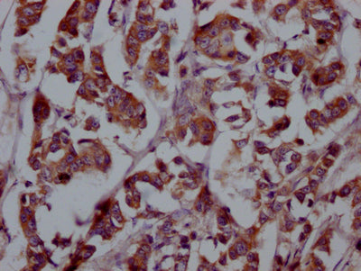 IHC image of CSB-RA927449A0HU diluted at 1:100 and staining in paraffin-embedded human breast cancer performed on a Leica BondTM system. After dewaxing and hydration, antigen retrieval was mediated by high pressure in a citrate buffer (pH 6.0) . Section was blocked with 10% normal goat serum 30min at RT. Then primary antibody (1% BSA) was incubated at 4℃ overnight. The primary is detected by a Goat anti-rabbit IgG polymer labeled by HRP and visualized using 0.05% DAB.