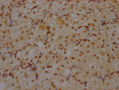 IHC image of CSB-RA930964A0HU diluted at 1:100 and staining in paraffin-embedded human ovarian tissue performed on a Leica BondTM system. After dewaxing and hydration, antigen retrieval was mediated by high pressure in a citrate buffer (pH 6.0) . Section was blocked with 10% normal goat serum 30min at RT. Then primary antibody (1% BSA) was incubated at 4℃ overnight. The primary is detected by a Goat anti-rabbit IgG polymer labeled by HRP and visualized using 0.05% DAB.
