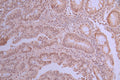 IHC image of CSB-RA935455A0HU diluted at 1:100 and staining in paraffin-embedded human colorectal cancer performed on a Leica BondTM system. After dewaxing and hydration, antigen retrieval was mediated by high pressure in a citrate buffer (pH 6.0) . Section was blocked with 10% normal goat serum 30min at RT. Then primary antibody (1% BSA) was incubated at 4°C overnight. The primary is detected by a Goat anti-rabbit polymer IgG labeled by HRP and visualized using 0.05% DAB.