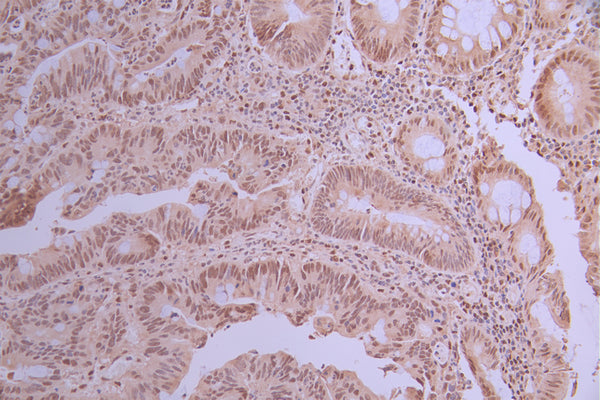 IHC image of CSB-RA935455A0HU diluted at 1:100 and staining in paraffin-embedded human colorectal cancer performed on a Leica BondTM system. After dewaxing and hydration, antigen retrieval was mediated by high pressure in a citrate buffer (pH 6.0) . Section was blocked with 10% normal goat serum 30min at RT. Then primary antibody (1% BSA) was incubated at 4°C overnight. The primary is detected by a Goat anti-rabbit polymer IgG labeled by HRP and visualized using 0.05% DAB.