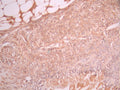 IHC image of CSB-RA937939A0HU diluted at 1:100 and staining in paraffin-embedded human breast cancer performed on a Leica BondTM system. After dewaxing and hydration, antigen retrieval was mediated by high pressure in a citrate buffer (pH 6.0). Section was blocked with 10% normal goat serum 30min at RT. Then primary antibody (1% BSA) was incubated at 4°C overnight. The primary is detected by a Goat anti-rabbit polymer IgG labeled by HRP and visualized using 0.05% DAB.