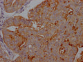 IHC image of CSB-RA941216A0HU diluted at 1:100 and staining in paraffin-embedded human endometrial cancer performed on a Leica BondTM system. After dewaxing and hydration, antigen retrieval was mediated by high pressure in a citrate buffer (pH 6.0) . Section was blocked with 10% normal goat serum 30min at RT. Then primary antibody (1% BSA) was incubated at 4℃ overnight. The primary is detected by a Goat anti-rabbit IgG polymer labeled by HRP and visualized using 0.05% DAB.