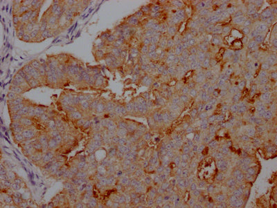 IHC image of CSB-RA941216A0HU diluted at 1:100 and staining in paraffin-embedded human endometrial cancer performed on a Leica BondTM system. After dewaxing and hydration, antigen retrieval was mediated by high pressure in a citrate buffer (pH 6.0) . Section was blocked with 10% normal goat serum 30min at RT. Then primary antibody (1% BSA) was incubated at 4℃ overnight. The primary is detected by a Goat anti-rabbit IgG polymer labeled by HRP and visualized using 0.05% DAB.