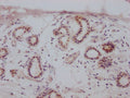 IHC image of CSB-RA942338A0HU diluted at 1:100 and staining in paraffin-embedded human breast cancer performed on a Leica BondTM system. After dewaxing and hydration, antigen retrieval was mediated by high pressure in a citrate buffer (pH 6.0) . Section was blocked with 10% normal goat serum 30min at RT. Then primary antibody (1% BSA) was incubated at 4℃ overnight. The primary is detected by a Goat anti-rabbit IgG polymer labeled by HRP and visualized using 0.05% DAB.