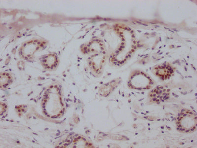 IHC image of CSB-RA942338A0HU diluted at 1:100 and staining in paraffin-embedded human breast cancer performed on a Leica BondTM system. After dewaxing and hydration, antigen retrieval was mediated by high pressure in a citrate buffer (pH 6.0) . Section was blocked with 10% normal goat serum 30min at RT. Then primary antibody (1% BSA) was incubated at 4℃ overnight. The primary is detected by a Goat anti-rabbit IgG polymer labeled by HRP and visualized using 0.05% DAB.