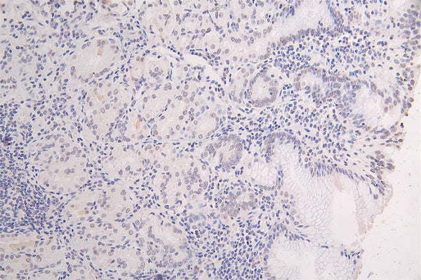 IHC image of CSB-RA943659A0HU diluted at 1:100 and staining in paraffin-embedded human gastric cancer performed on a Leica BondTM system. After dewaxing and hydration, antigen retrieval was mediated by high pressure in a citrate buffer (pH 6.0) . Section was blocked with 10% normal goat serum 30min at RT. Then primary antibody (1% BSA) was incubated at 4°C overnight. The primary is detected by a Goat anti-rabbit polymer IgG labeled by HRP and visualized using 0.08% DAB.