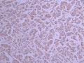 IHC image of CSB-RA947589A0HU diluted at 1:100 and staining in paraffin-embedded human breast cancer performed on a Leica BondTM system. After dewaxing and hydration, antigen retrieval was mediated by high pressure in a citrate buffer (pH 6.0) . Section was blocked with 10% normal goat serum 30min at RT. Then primary antibody (1% BSA) was incubated at 4°C overnight. The primary is detected by a Goat anti-rabbit polymer IgG labeled by HRP and visualized using 0.05% DAB.