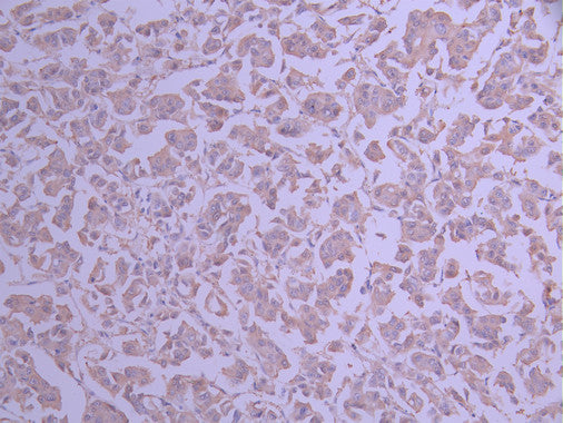 IHC image of CSB-RA947589A0HU diluted at 1:100 and staining in paraffin-embedded human breast cancer performed on a Leica BondTM system. After dewaxing and hydration, antigen retrieval was mediated by high pressure in a citrate buffer (pH 6.0) . Section was blocked with 10% normal goat serum 30min at RT. Then primary antibody (1% BSA) was incubated at 4°C overnight. The primary is detected by a Goat anti-rabbit polymer IgG labeled by HRP and visualized using 0.05% DAB.