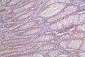 IHC image of CSB-RA950991A0HU diluted at 1:100 and staining in paraffin-embedded human rectal cancer performed on a Leica BondTM system. After dewaxing and hydration, antigen retrieval was mediated by high pressure in a citrate buffer (pH 6.0) . Section was blocked with 10% normal goat serum 30min at RT. Then primary antibody (1% BSA) was incubated at 4°C overnight. The primary is detected by a Goat anti-rabbit polymer IgG labeled by HRP and visualized using 0.14% DAB.