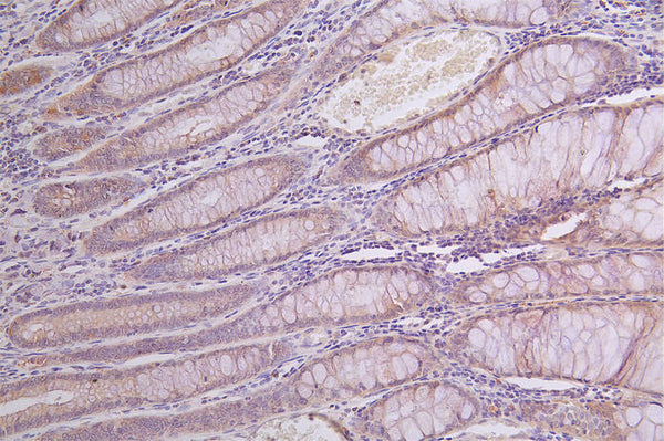 IHC image of CSB-RA950991A0HU diluted at 1:100 and staining in paraffin-embedded human rectal cancer performed on a Leica BondTM system. After dewaxing and hydration, antigen retrieval was mediated by high pressure in a citrate buffer (pH 6.0) . Section was blocked with 10% normal goat serum 30min at RT. Then primary antibody (1% BSA) was incubated at 4°C overnight. The primary is detected by a Goat anti-rabbit polymer IgG labeled by HRP and visualized using 0.14% DAB.