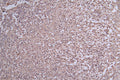 IHC image of CSB-RA956089A0HU diluted at 1:50 and staining in paraffin-embedded human glioma cancer performed on a Leica BondTM system. After dewaxing and hydration, antigen retrieval was mediated by high pressure in a citrate buffer (pH 6.0) . Section was blocked with 10% normal goat serum 30min at RT. Then primary antibody (1% BSA) was incubated at 4°C overnight. The primary is detected by a Goat anti-rabbit polymer IgG labeled by HRP and visualized using 0.29% DAB.