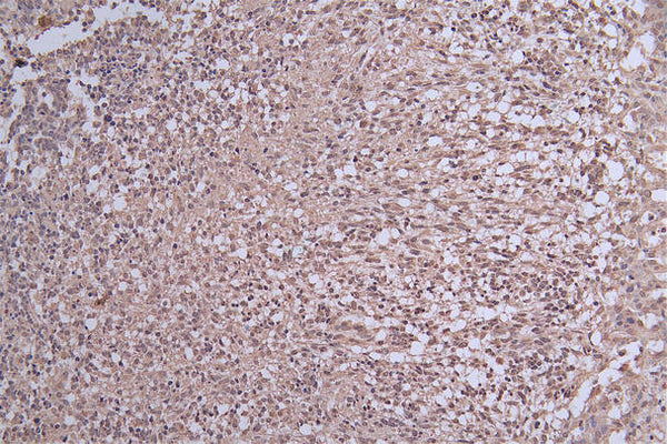 IHC image of CSB-RA956089A0HU diluted at 1:50 and staining in paraffin-embedded human glioma cancer performed on a Leica BondTM system. After dewaxing and hydration, antigen retrieval was mediated by high pressure in a citrate buffer (pH 6.0) . Section was blocked with 10% normal goat serum 30min at RT. Then primary antibody (1% BSA) was incubated at 4°C overnight. The primary is detected by a Goat anti-rabbit polymer IgG labeled by HRP and visualized using 0.29% DAB.