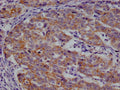 IHC image of CSB-RA959139A0HU diluted at 1:100 and staining in paraffin-embedded human colon cancer performed on a Leica BondTM system. After dewaxing and hydration, antigen retrieval was mediated by high pressure in a citrate buffer (pH 6.0) . Section was blocked with 10% normal goat serum 30min at RT. Then primary antibody (1% BSA) was incubated at 4°C overnight. The primary is detected by a Goat anti-rabbit polymer IgG labeled by HRP and visualized using 0.05% DAB.