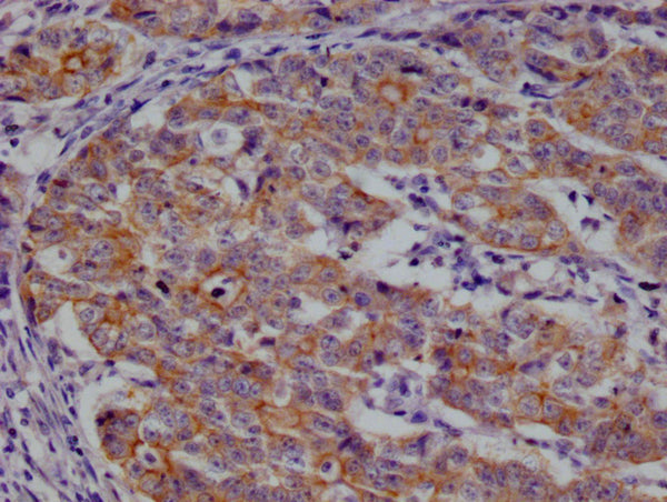 IHC image of CSB-RA959139A0HU diluted at 1:100 and staining in paraffin-embedded human colon cancer performed on a Leica BondTM system. After dewaxing and hydration, antigen retrieval was mediated by high pressure in a citrate buffer (pH 6.0) . Section was blocked with 10% normal goat serum 30min at RT. Then primary antibody (1% BSA) was incubated at 4°C overnight. The primary is detected by a Goat anti-rabbit polymer IgG labeled by HRP and visualized using 0.05% DAB.