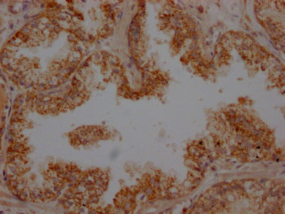 IHC image of CSB-RA963043A0HU diluted at 1:100 and staining in paraffin-embedded human prostate cancer performed on a Leica BondTM system. After dewaxing and hydration, antigen retrieval was mediated by high pressure in a citrate buffer (pH 6.0) . Section was blocked with 10% normal goat serum 30min at RT. Then primary antibody (1% BSA) was incubated at 4℃ overnight. The primary is detected by a Goat anti-rabbit IgG polymer labeled by HRP and visualized using 0.05% DAB.