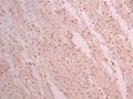 IHC image of CSB-RA964866A0HU diluted at 1:100 and staining in paraffin-embedded human glioma cancer performed on a Leica BondTM system. After dewaxing and hydration, antigen retrieval was mediated by high pressure in a citrate buffer (pH 6.0) . Section was blocked with 10% normal goat serum 30min at RT. Then primary antibody (1% BSA) was incubated at 4°C overnight. The primary is detected by a Goat anti-rabbit polymer IgG labeled by HRP and visualized using 0.05% DAB.
