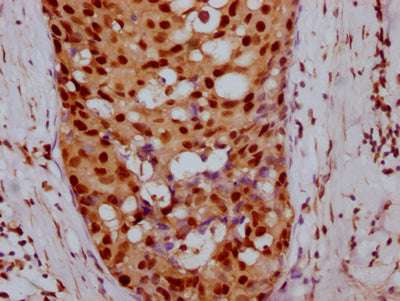 IHC image of CSB-RA968740A0HU diluted at 1:100 and staining in paraffin-embedded human breast cancer performed on a Leica BondTM system. After dewaxing and hydration, antigen retrieval was mediated by high pressure in a citrate buffer (pH 6.0) . Section was blocked with 10% normal goat serum 30min at RT. Then primary antibody (1% BSA) was incubated at 4℃ overnight. The primary is detected by a Goat anti-rabbit IgG polymer labeled by HRP and visualized using 0.05% DAB.