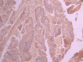 IHC image of CSB-RA969203A0HU diluted at 1:100 and staining in paraffin-embedded human colorectal cancer performed on a Leica BondTM system. After dewaxing and hydration, antigen retrieval was mediated by high pressure in a citrate buffer (pH 6.0) . Section was blocked with 10% normal goat serum 30min at RT. Then primary antibody (1% BSA) was incubated at 4°C overnight. The primary is detected by a Goat anti-rabbit polymer IgG labeled by HRP and visualized using 0.05% DAB.