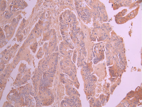 IHC image of CSB-RA969203A0HU diluted at 1:100 and staining in paraffin-embedded human colorectal cancer performed on a Leica BondTM system. After dewaxing and hydration, antigen retrieval was mediated by high pressure in a citrate buffer (pH 6.0) . Section was blocked with 10% normal goat serum 30min at RT. Then primary antibody (1% BSA) was incubated at 4°C overnight. The primary is detected by a Goat anti-rabbit polymer IgG labeled by HRP and visualized using 0.05% DAB.