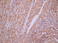 IHC image of CSB-RA970878A0HU diluted at 1:100 and staining in paraffin-embedded human liver cancer performed on a Leica BondTM system. After dewaxing and hydration, antigen retrieval was mediated by high pressure in a citrate buffer (pH 6.0). Section was blocked with 10% normal goat serum 30min at RT. Then primary antibody (1% BSA) was incubated at 4°C overnight. The primary is detected by a Goat anti-rabbit polymer IgG labeled by HRP and visualized using 0.05% DAB.