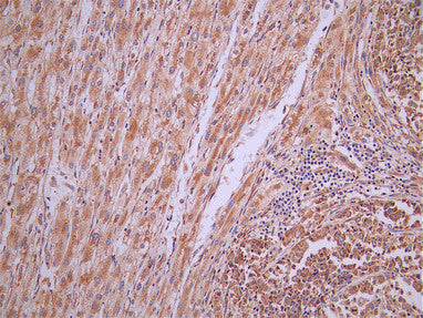 IHC image of CSB-RA970878A0HU diluted at 1:100 and staining in paraffin-embedded human liver cancer performed on a Leica BondTM system. After dewaxing and hydration, antigen retrieval was mediated by high pressure in a citrate buffer (pH 6.0). Section was blocked with 10% normal goat serum 30min at RT. Then primary antibody (1% BSA) was incubated at 4°C overnight. The primary is detected by a Goat anti-rabbit polymer IgG labeled by HRP and visualized using 0.05% DAB.