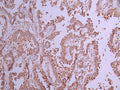 IHC image of CSB-RA976601A0HU diluted at 1:100 and staining in paraffin-embedded human lung cancer performed on a Leica BondTM system. After dewaxing and hydration, antigen retrieval was mediated by high pressure in a citrate buffer (pH 6.0) . Section was blocked with 10% normal goat serum 30min at RT. Then primary antibody (1% BSA) was incubated at 4°C overnight. The primary is detected by a Goat anti-rabbit polymer IgG labeled by HRP and visualized using 0.05% DAB.