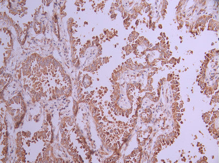 IHC image of CSB-RA976601A0HU diluted at 1:100 and staining in paraffin-embedded human lung cancer performed on a Leica BondTM system. After dewaxing and hydration, antigen retrieval was mediated by high pressure in a citrate buffer (pH 6.0) . Section was blocked with 10% normal goat serum 30min at RT. Then primary antibody (1% BSA) was incubated at 4°C overnight. The primary is detected by a Goat anti-rabbit polymer IgG labeled by HRP and visualized using 0.05% DAB.