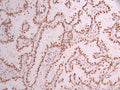 IHC image of CSB-RA983870A0HU diluted at 1:100 and staining in paraffin-embedded human lung cancer performed on a Leica BondTM system. After dewaxing and hydration, antigen retrieval was mediated by high pressure in a citrate buffer (pH 6.0) . Section was blocked with 10% normal goat serum 30min at RT. Then primary antibody (1% BSA) was incubated at 4°C overnight. The primary is detected by a Goat anti-rabbit polymer IgG labeled by HRP and visualized using 0.05% DAB.