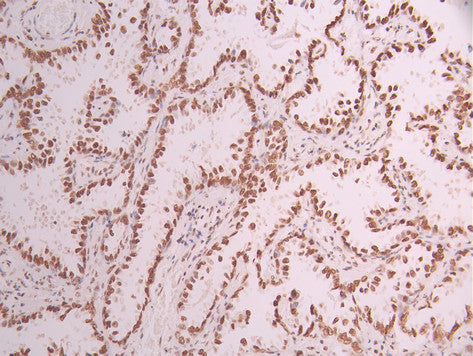 IHC image of CSB-RA983870A0HU diluted at 1:100 and staining in paraffin-embedded human lung cancer performed on a Leica BondTM system. After dewaxing and hydration, antigen retrieval was mediated by high pressure in a citrate buffer (pH 6.0) . Section was blocked with 10% normal goat serum 30min at RT. Then primary antibody (1% BSA) was incubated at 4°C overnight. The primary is detected by a Goat anti-rabbit polymer IgG labeled by HRP and visualized using 0.05% DAB.